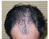 Hair restoration before