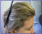Female forehead showing thickening hair line