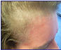 Female forehead showing receding hair line