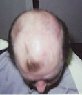 Before Hair restoration