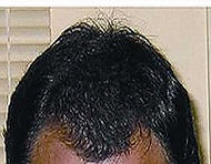 Hair restoration after