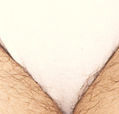 Laser Bikini Before
