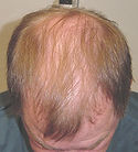 After 3 months hair restoration
