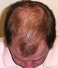After 6 months hair restoration