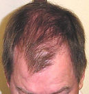 After 12 months hair restoration