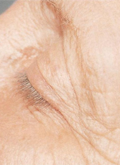 Wrinkles-ahg
