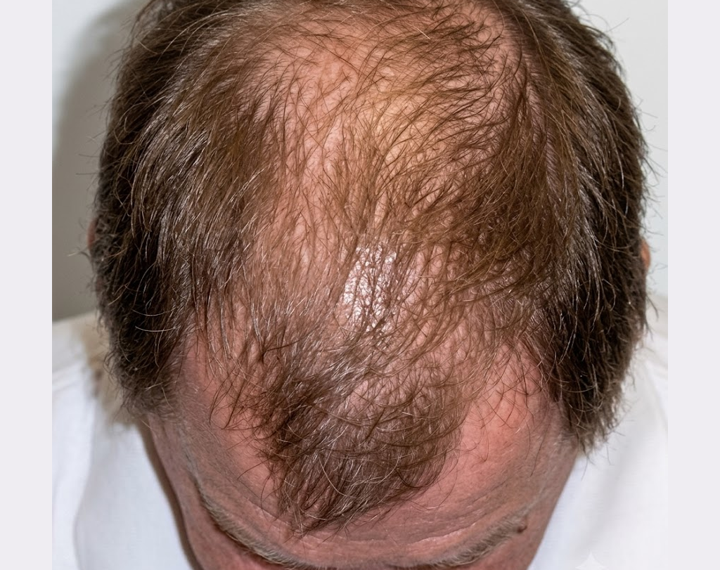 After 6 months hair restoration