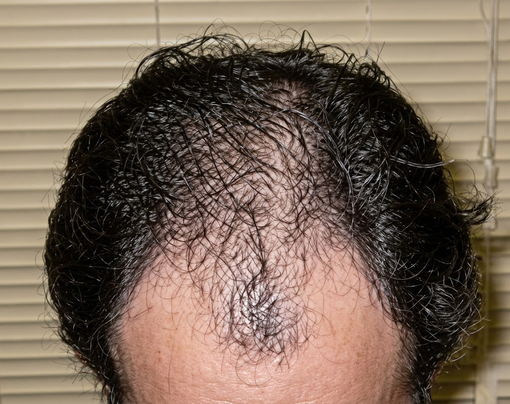 Hair restoration before