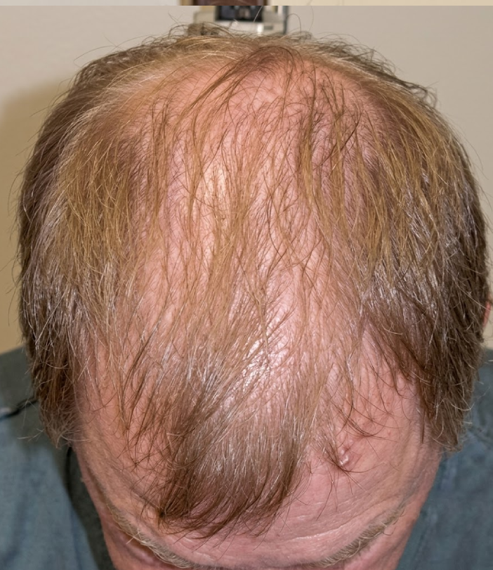 After 3 months hair restoration